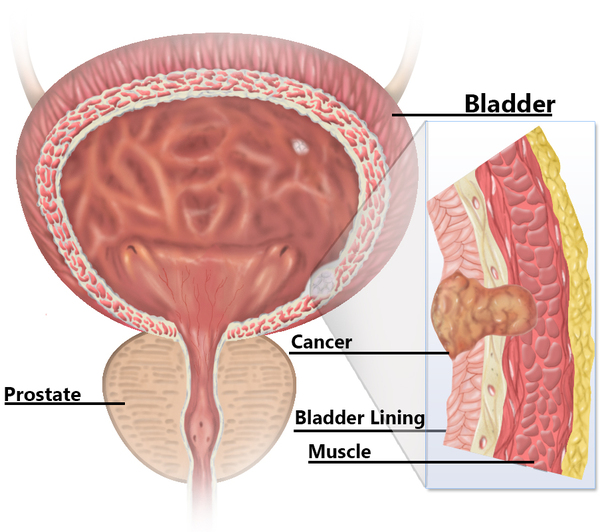 Bladder Cancer Treatment 