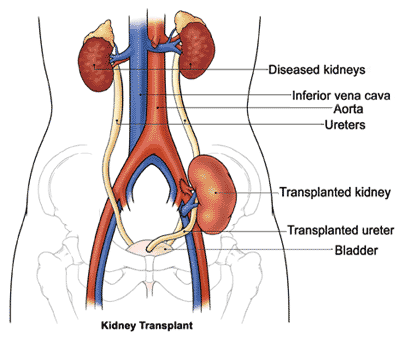 Cadaveric Kidney Transplant
