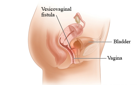Vesico Vaginal Fistula