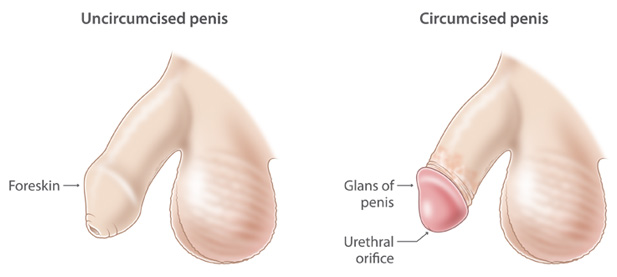 Circumcision Treatment