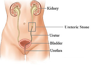 ureteric stone
