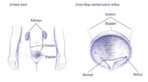 Ureteric reimplantation chennai