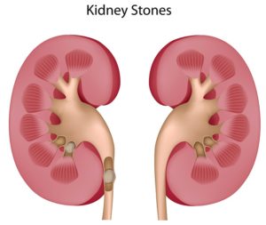 kidney stone treatment chennai 